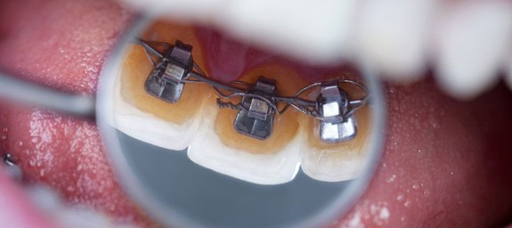 Исправление прикуса (ортодонтия)