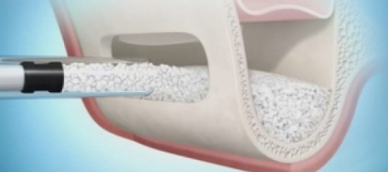 Синус-лифтинг