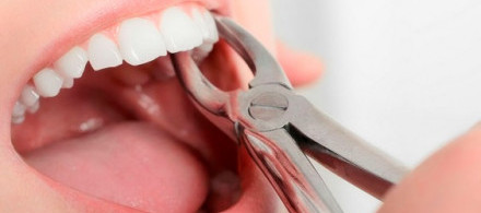 Удаление зуба