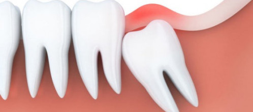 Удаление зуба мудрости